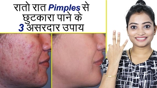 रातो रात Pimples से छुटकारा पाने के 3 असरदार उपाय  How to Get Rid of Pimples Overnight [upl. by Yatnoj662]