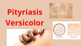 Comment guérir le Mycose cutanée Pityriasis versicolor [upl. by Genovera]