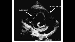 Hypokinesia Dyskinesia and Akinesia in a Single Echocardiography Frame [upl. by Chinua]