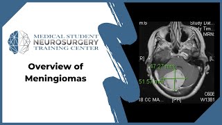 Overview of Meningiomas [upl. by Ordnazil]