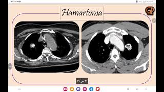 3 Lung Lesions  tuberculoma vs Hamartoma [upl. by Carla]