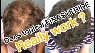 Man uses topical Finasteride and Minoxiidil to regrow hair [upl. by Erbes]