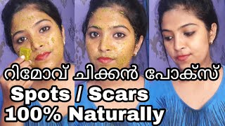 How To Remove chicken pox spots  scars 100 naturally just in 10 days  Malayali Youtuber [upl. by Blaze]