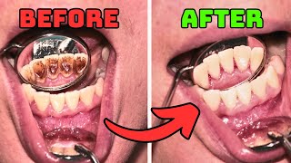 7 Tips to Remove PLAQUE and TARTAR From Teeth Naturally [upl. by Repip]