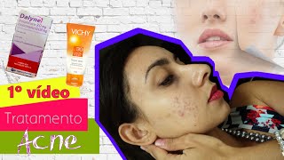 1ª Video Tratamento da acne com Tetraciclina e Creme Adapaleno [upl. by Frasquito]