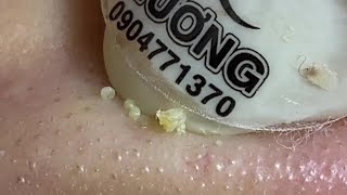 Acne Treatment Huong Da Nang  2024 blackheads 710 [upl. by Hgielrac517]