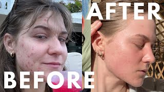 How I CLEARED My Hormonal Acne [upl. by Mandi902]