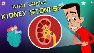 What Causes Kidney Stones  The Dr Binocs Show  Best Learning Videos For Kids  Peekaboo Kidz [upl. by Akcimehs]