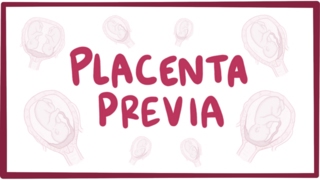 Placenta previa  causes symptoms diagnosis treatment pathology [upl. by Alegnaed]