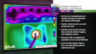 Catheter Ablation of Cardiac Arrhythmias 2nd Edition [upl. by Bates]