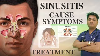 सायनस बीमारी क्या होता है  SINUSITIS CAUSE SYMPTOMS TREATMENT headache sinusitistreatment [upl. by Llevad60]