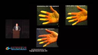 Raynauds Phenomenon Systemic Sclerosis And Capillaroscopy  Maurizio Cutolo MD [upl. by Chaddy]