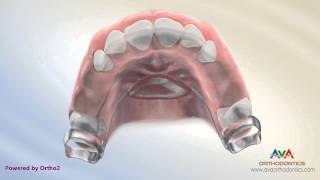 Orthodontic Space Management  Nance Appliance [upl. by Munniks372]