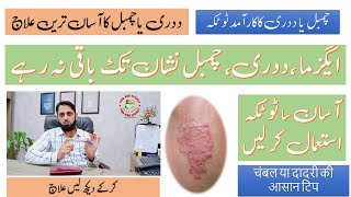 Chambal ka ilaj  Dadri ka ilaj in urdu  Eczema treatment  Eczema treatment at home remedies [upl. by Eineg]