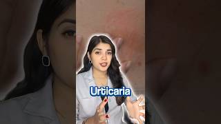 How I Cured My Urticaria Chronic Hives  My Story [upl. by Barret]