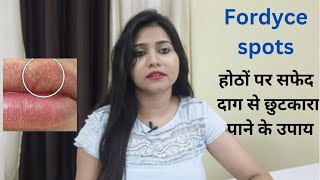 Fordyce spots  होठों पर सफेद दाग से छुटकारा पाने के उपाय  Fordyce spots Homeopathic medicine [upl. by Fernanda]