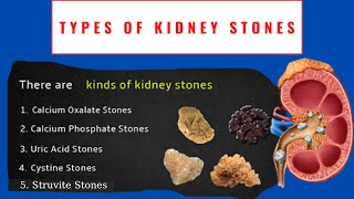 Things To Know About Kidney Stones  Types Of Kidney Stones  247nht [upl. by An789]