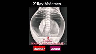 Tension Hydro  Pneumoperitoneum   Diagnosis Abdominal X Ray [upl. by Afatsum]