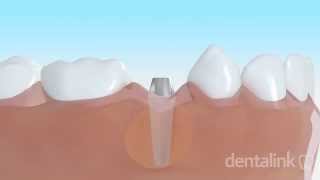 IMPLANTE DENTAL óseo integrado  Video 3D paso a paso [upl. by Yousuf193]