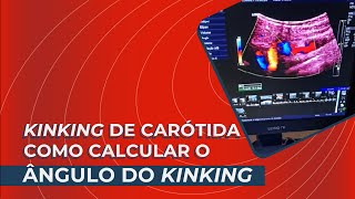 Kinking de Carótida  Como Calcular o ângulo do Kinking [upl. by Okiam411]