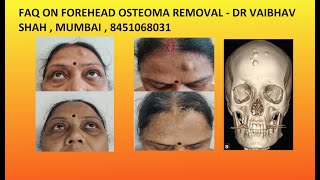 Frequently asked Questions on Forehead osteoma removal surgery in India [upl. by Oliver]