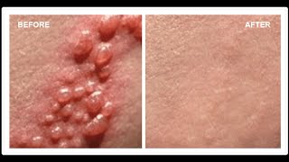 How To Cure Herpes  Cures for Herpes  Herpes Cures [upl. by Eugenio]