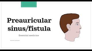 Preauricular sinusfistula Essential medicine [upl. by Neisa]