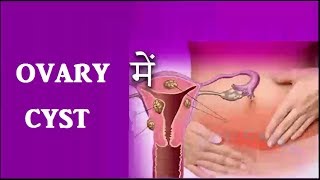 Ovary में Cyst या बच्चे न होना तो करे यह रामबांड उपाय  Ovary Cyst Treatment [upl. by Addie448]