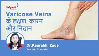 Varicose Veins के लक्षण कारण और निदान  Varicose Veins in Hindi  Dr Kaurabhi Zade Sahyadri [upl. by Nnaj]