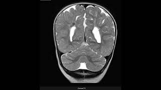 Leucomalácia periventricular [upl. by Annaerda316]