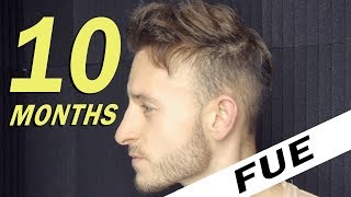 FUE Hair Transplant 10 Months post op Istanbul Turkey [upl. by Amar311]