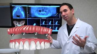 All on 4 Dental Implants Explained [upl. by Bigot]