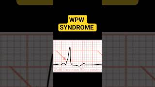 WPW SYNDROME [upl. by Oam]