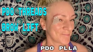 PDO PLLA THREADS for quick brow lift [upl. by Yenittirb]