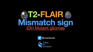 T2FLAIR Mismatch sign [upl. by Stephani]