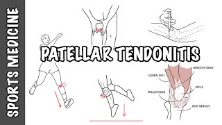 Patellar Tendonitis and Patellar Tendinopathy [upl. by Fisken390]