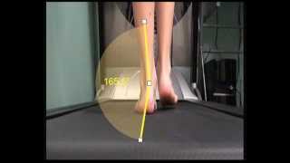 Over Pronation and how this is measured in walking [upl. by Mullen521]