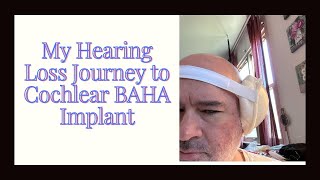 My Hearing Loss Journey to Cochlear BAHA Implant [upl. by Aicerg]