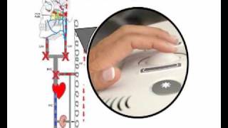 Dr Zambonis CCSVI Doppler Demonstration [upl. by Refynnej669]