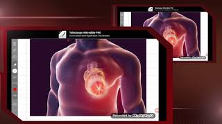 🔵Infarctus du myocardeclinique et physiopathologie [upl. by Atiuqehs]