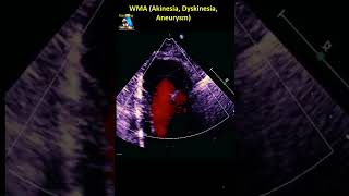 WMA Akinesia Dyskinesia Aneurysm [upl. by Lein]