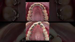 Lingual braces process [upl. by Yanehs]