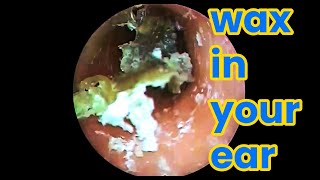 Ear picking  Cleaning earwax asmr ear cleaning wax in your ear Ear health ear piercing cleaning [upl. by Ydnis]