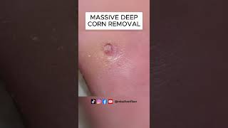 MASSIVE DEEP CORN REMOVAL BY MISS FOOT FIXER [upl. by Levine]