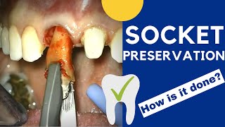 Tooth extraction and SOCKET PRESERVATION  How is it done [upl. by Ramalahs549]