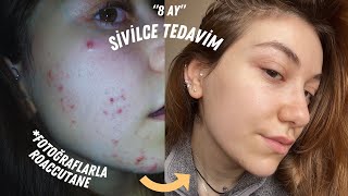 ROACCUTANE  ZORETANİN TEDAVİ SÜRECİM  SİVİLCE TEDAVİSİ NASIL HİÇ LEKEM YOK [upl. by Stephenie216]