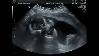 Ultrasound for pregnancy gyne obs ultrasound [upl. by Elianora851]