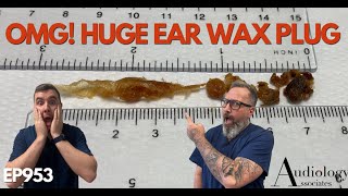 OMG HUGE EAR WAX PLUG REMOVED  EP953 [upl. by Zsuedat449]