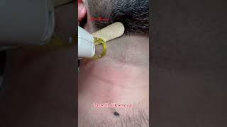 Laser Hair Removal getsmarthairclub viralvideo viralshorts [upl. by Lait94]