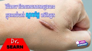 Natural Remedies to Remove Keloids វិធីងាយៗដែលអាចសាកល្បងបានក្នុងការបំបាត់ស្នាមផ្លែលើស្បែក [upl. by Reisch541]